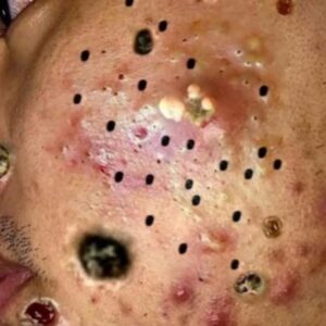 Their acne is severe