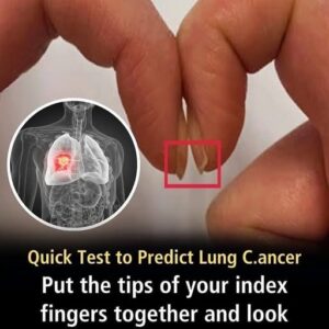 Finger Test For Lung Cancer Could Determine Cancer Risk