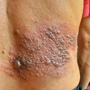 Young woman dies at the hands of her…See moreIt was itching his body, he thought it was an allergy, but a tough diagnosis… See more