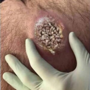 Their acne is severe